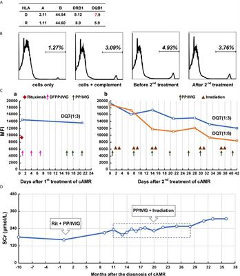 Case Report: Splenic Irradiation for the Treatment of Chronic Active Antibody-Mediated Rejection in Kidney Allograft Recipients With De Novo Donor-Specific Antibodies